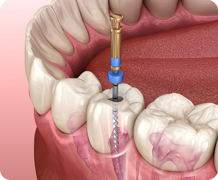 Dịch vụ: Điều trị tủy răng