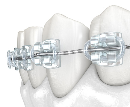 Dịch vụ: Niềng răng mắc cài sứ