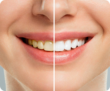 Dịch vụ: Tẩy trắng răng