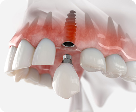 Dịch vụ: Trồng răng Implant 1 răng