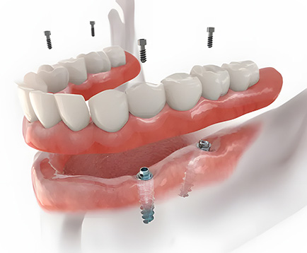 Dịch vụ: Trồng răng Implant cho Việt Kiều