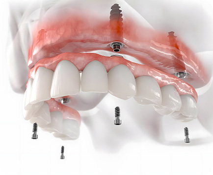 Dịch vụ: Trồng răng Implant toàn hàm