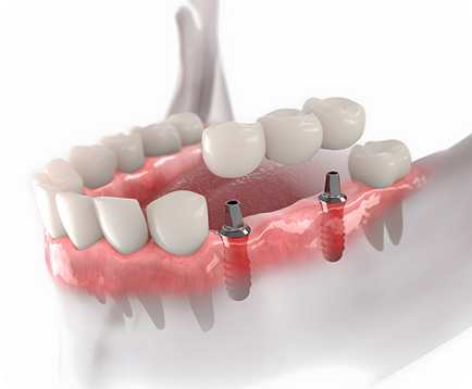 Dịch vụ: Trồng răng Implant vài răng