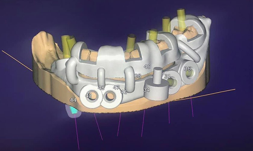>Máng hướng dẫn cấy ghép implant nhiều tầng