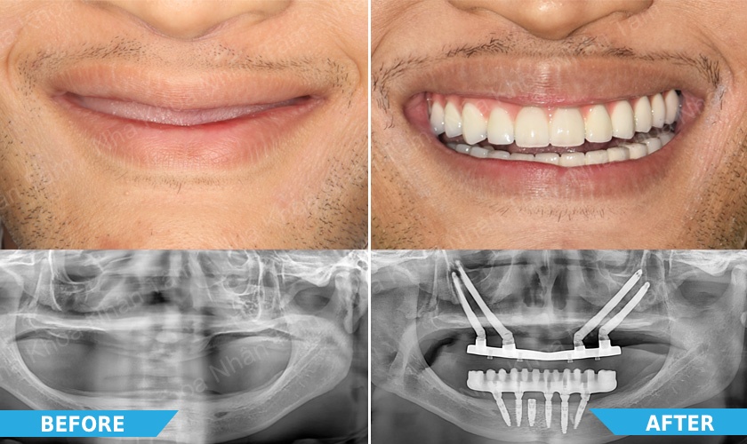 Literally toothless man treated by doctors in Ho Chi Minh City