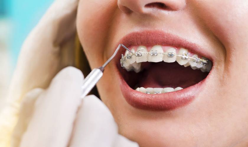 Braces consultation process