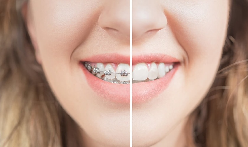 Braces for diviated teeth