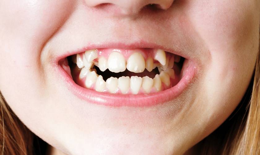 Causes of a faulty bite