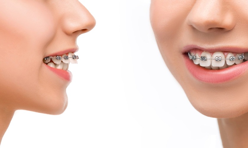 Effective cosmetic brace at Nhan Tam Dental