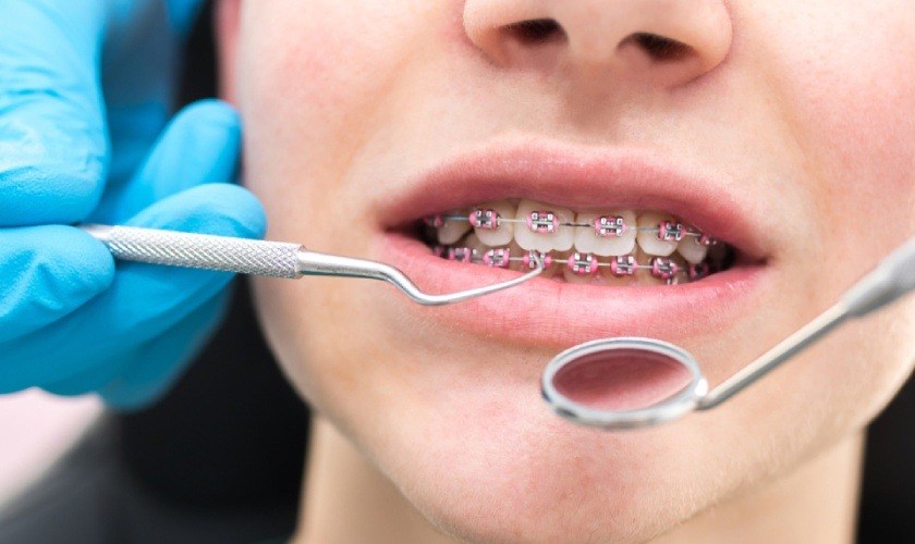 Cosmetic braces help pull teeth into the correct position on the jaw