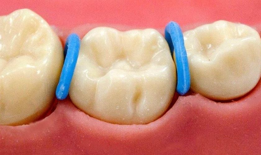 Gắn thun tách kẽ trước khi niềng răng