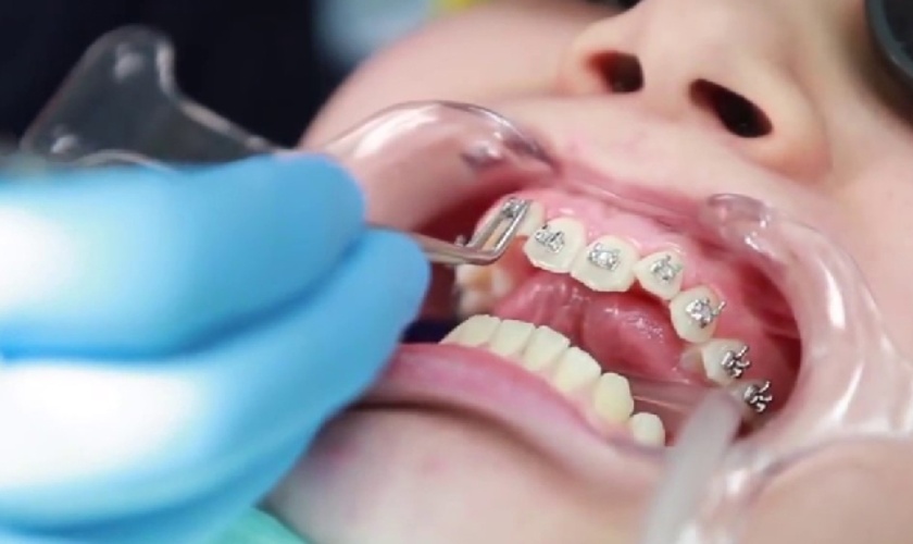 Răng đều đẹp thì tháo mắc cài