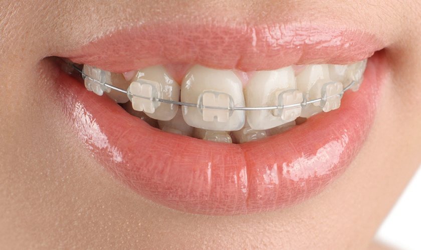 Niềng răng mắc cài sứ có chi phí hợp lý