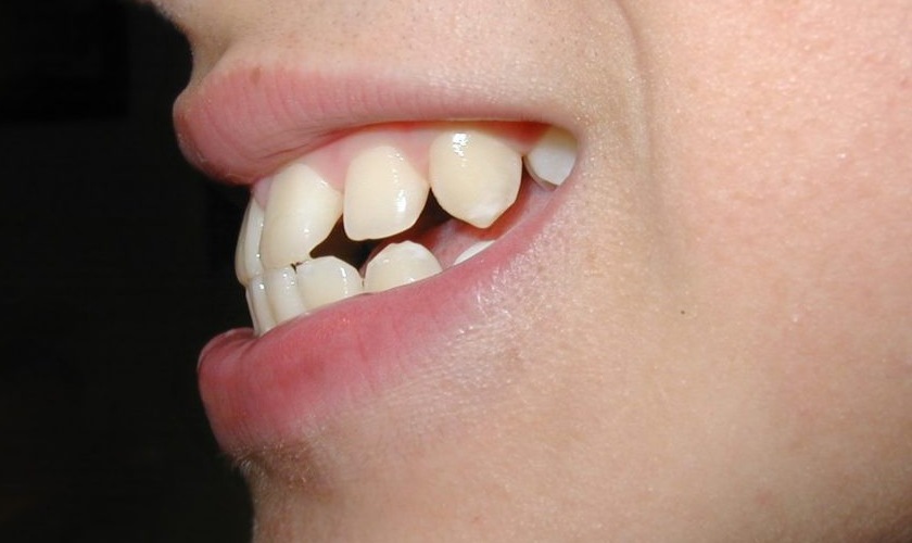 Răng hô cần phải nhổ bớt răng khi niềng