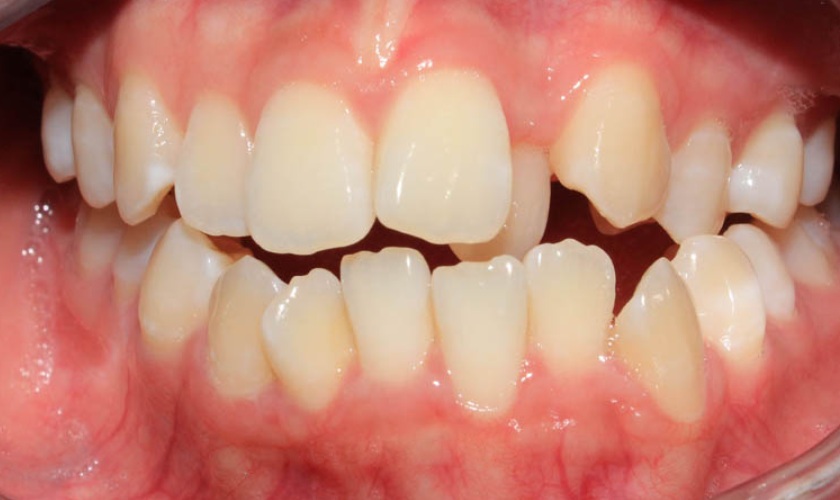 Răng mọc chen chúc không đủ khoảng trống để niềng răng
