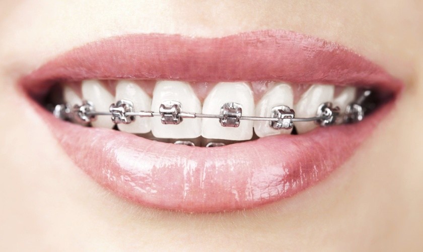 Metal braces