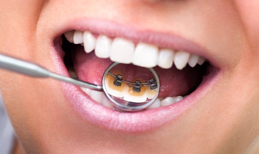 Lingual braces require a good and experienced doctor