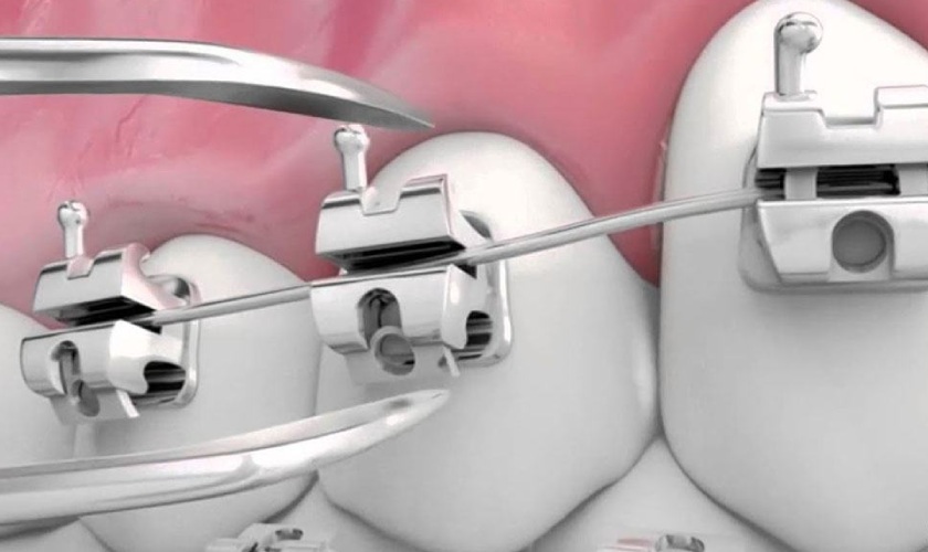 Niềng răng mắc cài tự buộc