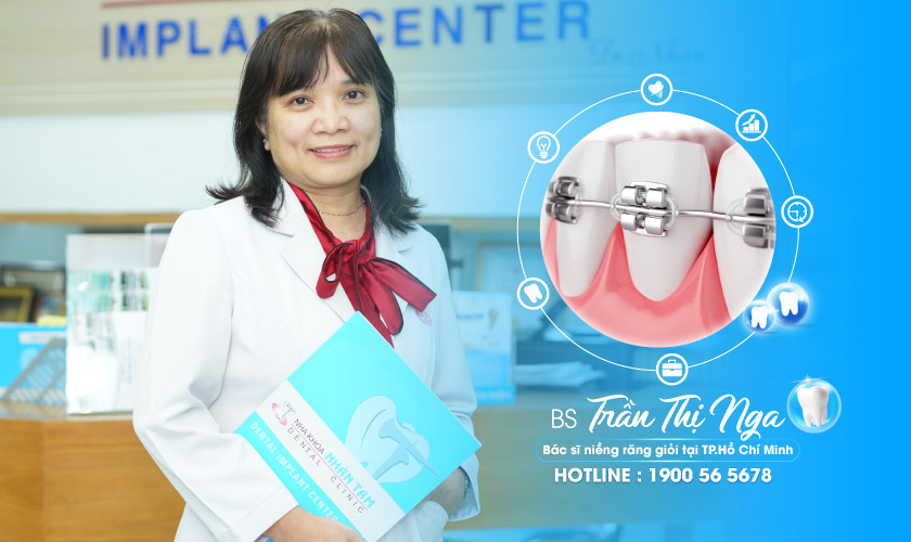 Dental Orthodontics - Price list for braces at Nhan Tam 2026
