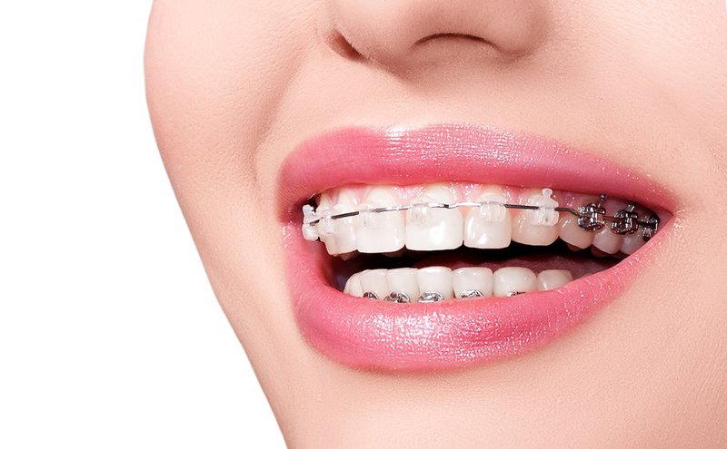 Should we have braces for impacted teeth?