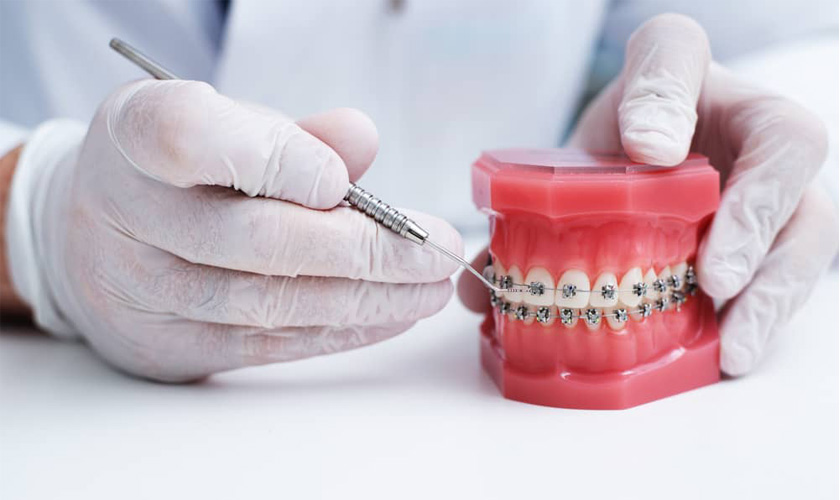 Things to know when braces