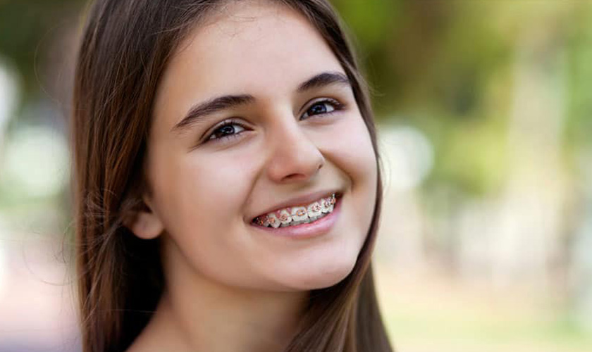 Hình: Types of braces today