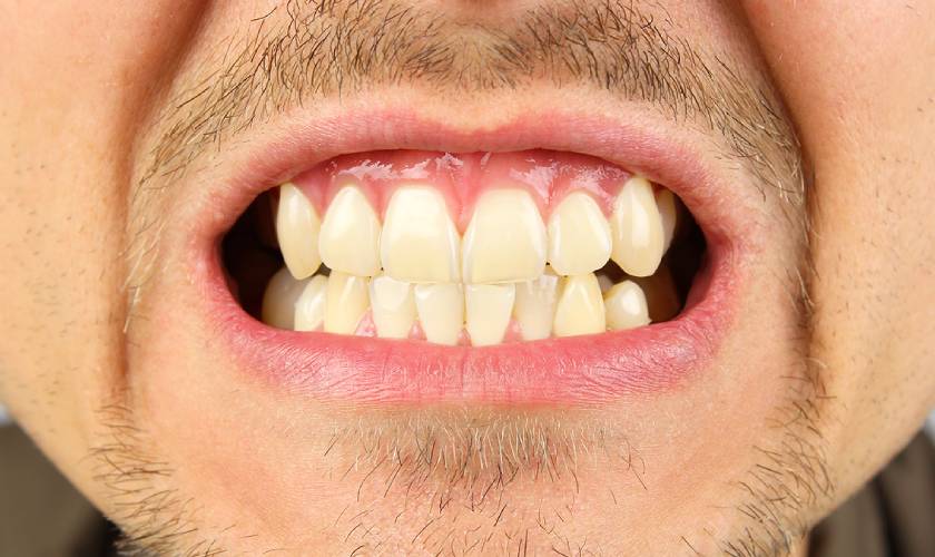 Common causes of bruxism