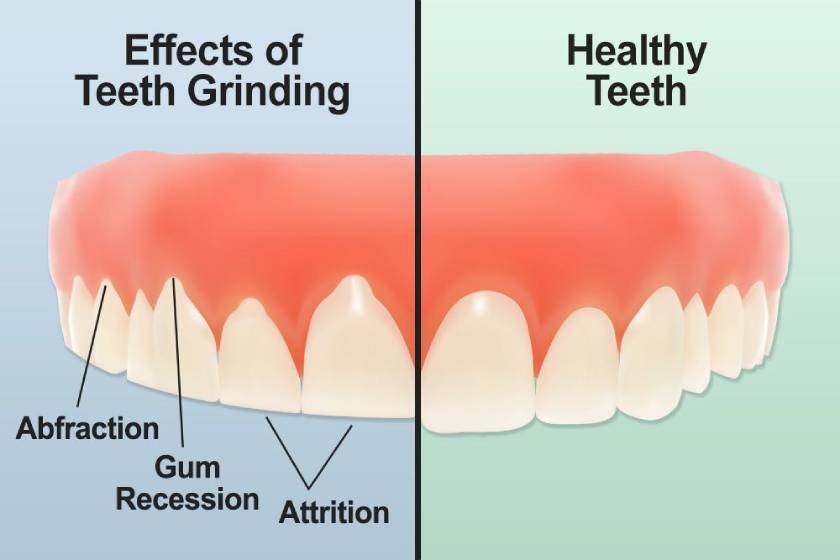 Symptoms of bruxism