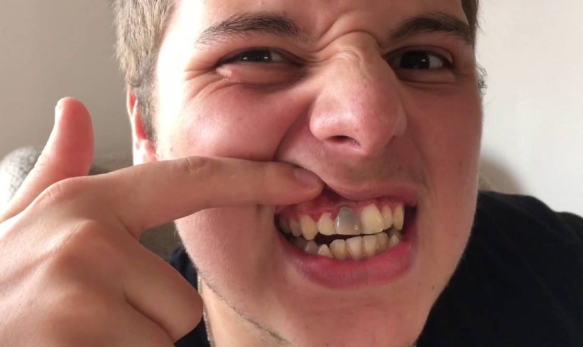dental filling