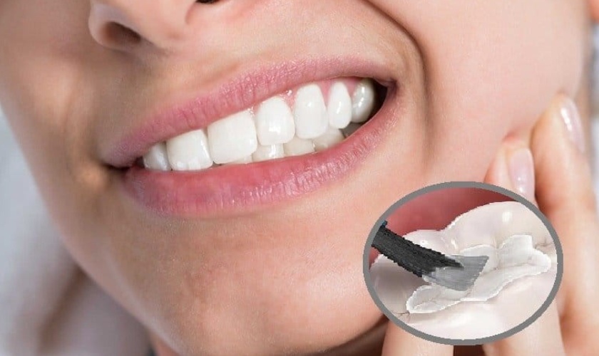 dental filling