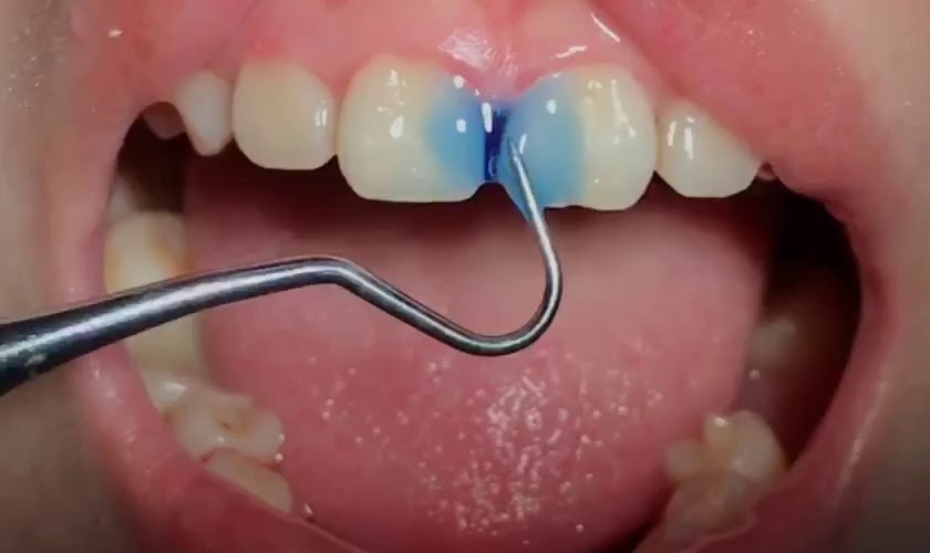 dental filling