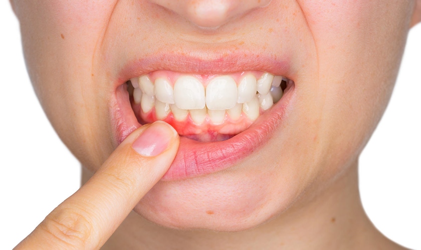 Q & A about cosmetic fillings