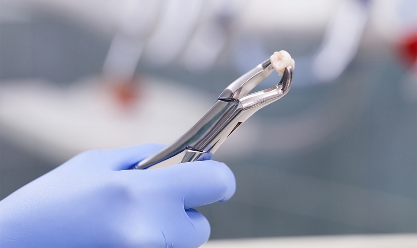 tooth extraction
