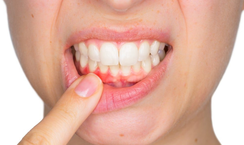 periodontal disease