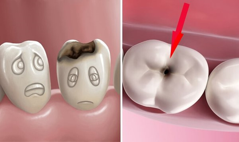 Allo doctors: Q & A about tooth decay prevention