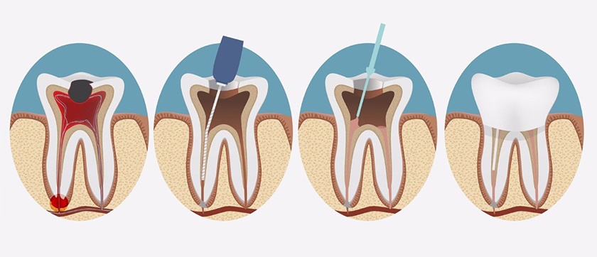 What is Pulp removal before tooth fillings?