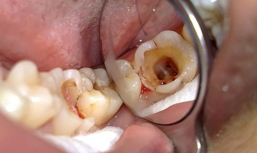 Pulp removals in severe tooth decay are often unavoidable