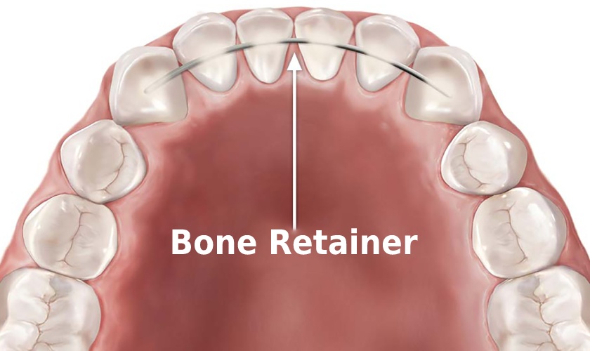 FAQ: Bonded wire retainer