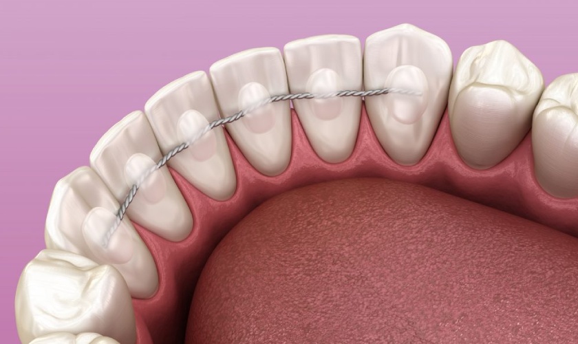 Bonded wire retainer