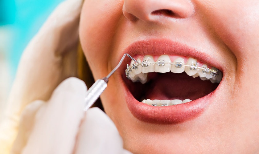 FAQ: Fixed braces (Train track)