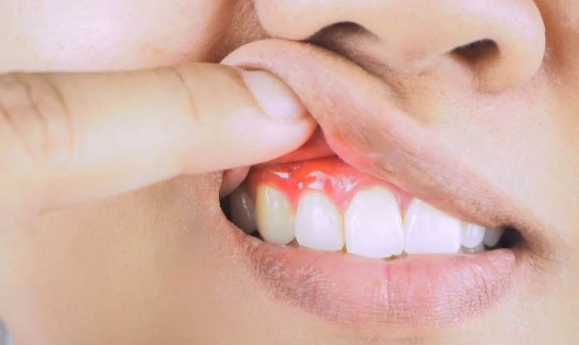 FAQ: Gum disease