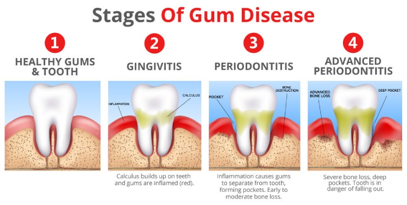 Gum disease