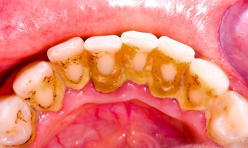 Gum disease