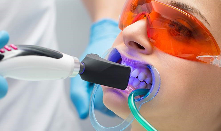 Laser whitening