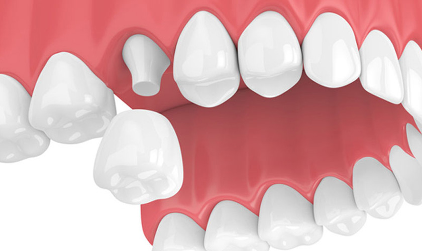 FAQ: Porcelain crown