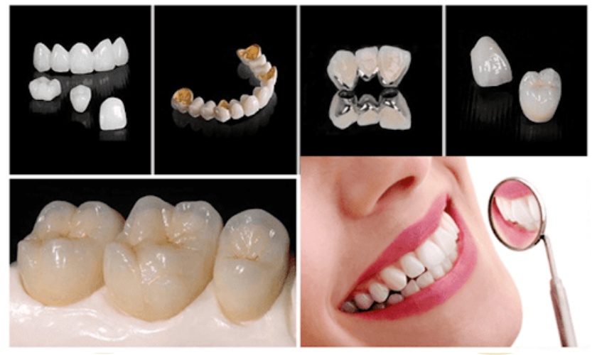 Porcelain crown