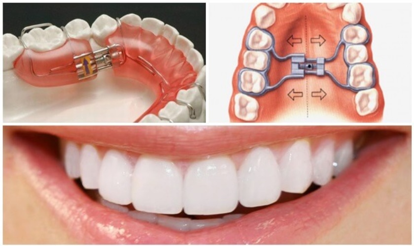 FAQ: Rapid maxillary expander
