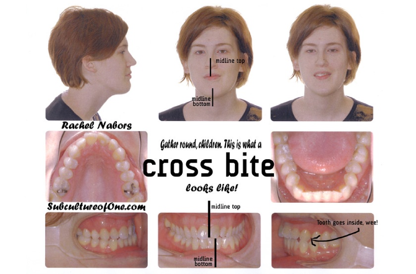 Rapid maxillary expander