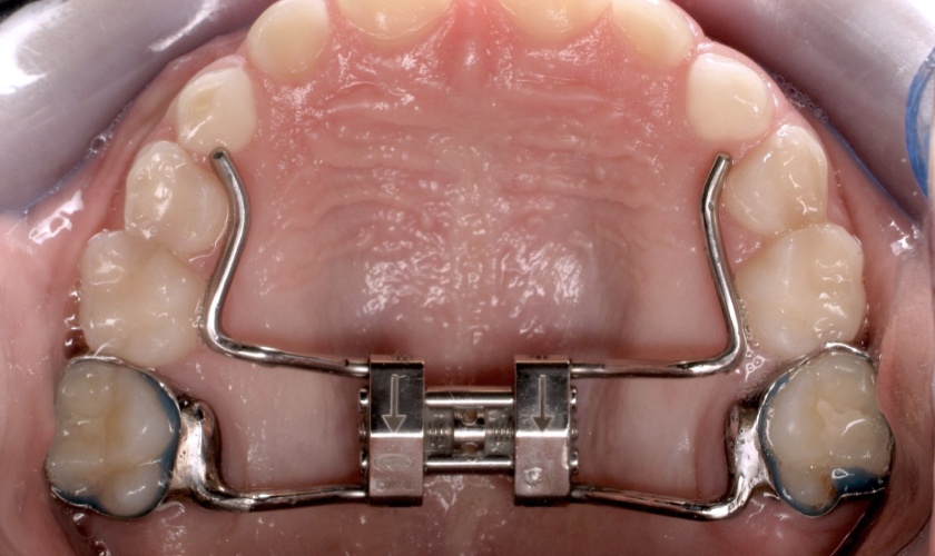 Rapid maxillary expander