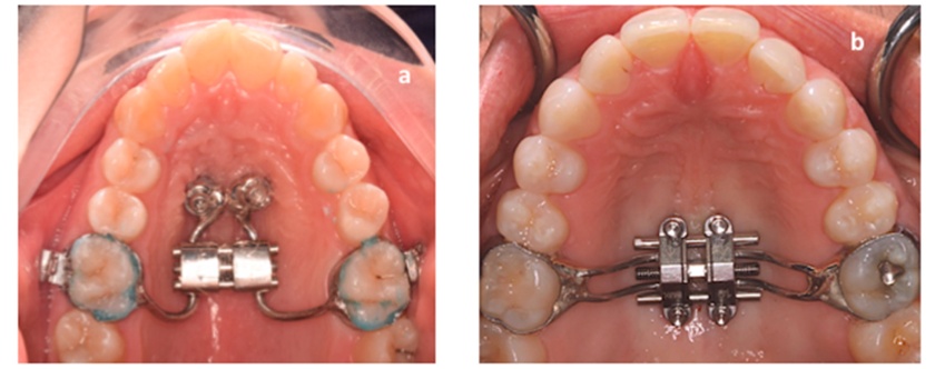 Rapid maxillary expander